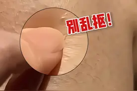 手臂、大腿上疙疙瘩瘩很难看，皮肤科医生教你低成本处理#鸡皮#鸡皮疙瘩#变美#硬核健康科普行动10%#尿素身体乳