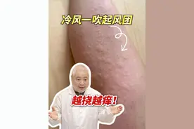好冷啊！怎么还长蚊子包了？ #科普 #寒冷性荨麻疹 #荨麻疹 #冬天 #抖出健康知识宝藏视频封面