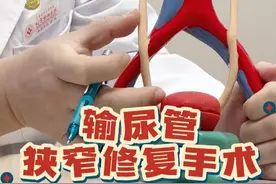 今天利用模型，来给大家直观的讲解一下输尿管狭窄的修复手术！#输尿管狭窄 #肾积水 #机器人手术 #硬核健康科普行动  #健康冷知识知多少视频封面
