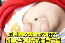 四岁男孩黑痣逐渐变大，家里人担心变成黑色素瘤 #肿瘤免疫博士汪治宇 #肿瘤 @抖音医疗健康小助手视频封面