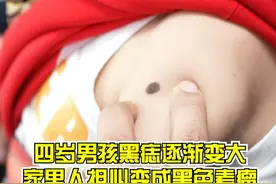 四岁男孩黑痣逐渐变大，家里人担心变成黑色素瘤 #肿瘤免疫博士汪治宇 #肿瘤 @抖音医疗健康小助手视频封面