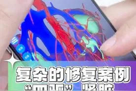 “四驱肾脏”是怎么回事？高难度先天畸形修复案例分享#马蹄肾  #机器人手术  #肾积水  #硬核健康科普行动视频封面