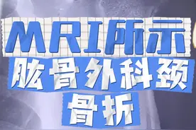 MRI所示肱骨外科颈骨折 #医学影像 #医学生 #放射科 #肱骨骨折视频封面