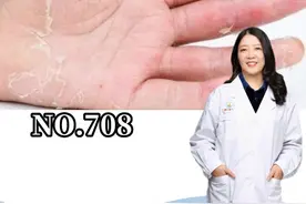 手掌手指反复脱皮，指纹都不能用，教你一个办法解决 #剥脱性角质松解症  #脱皮  #科普视频封面