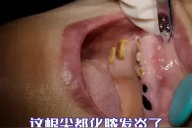 牙齿化脓鼓包，患者想一步解决！ #种植牙 #种牙视频封面