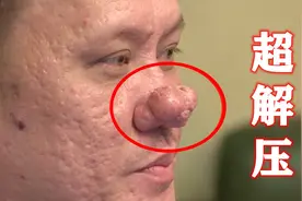 . 男人鼻子长了超大痘痘，闻起来臭气熏天，挤干净过程太解压！
