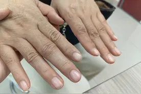 诸君，请看看您的手，有这种小结节吗？疼吗？图片