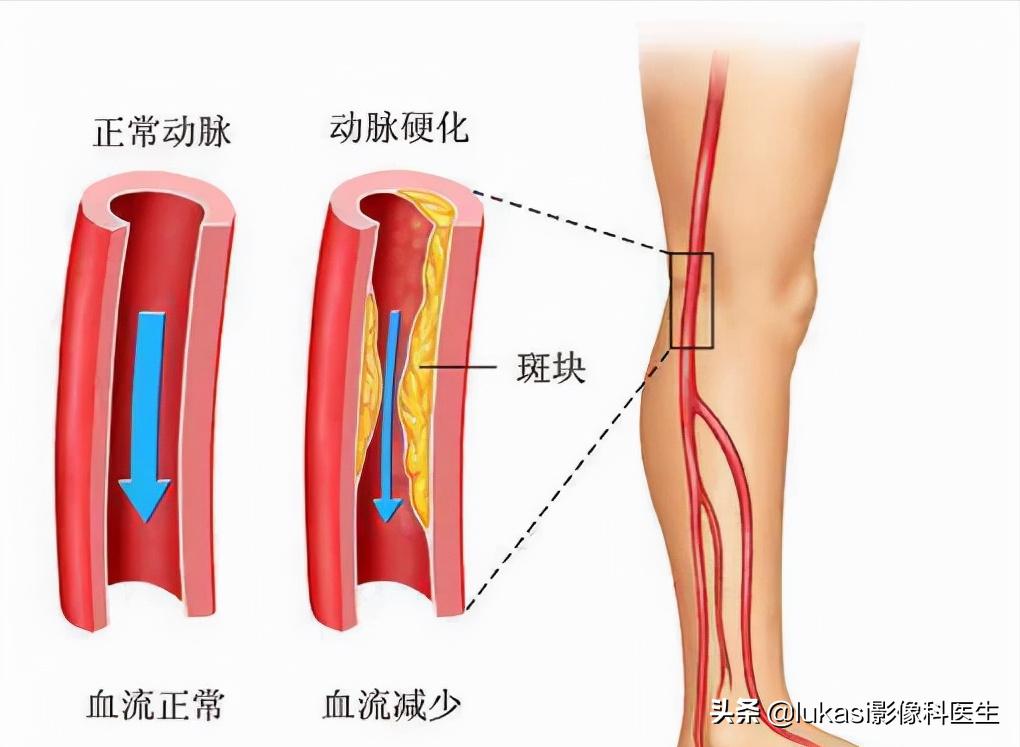“腿梗”到底有多凶险