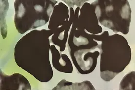 鼻中隔手术感受 这个鼻子不通气图片
