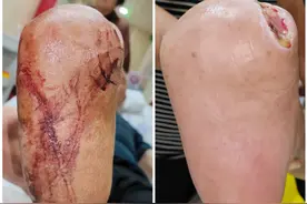 糖尿病足患者的脚很酸臭，洗干净后家属却意见很大图片