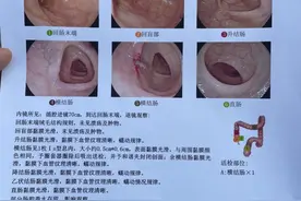 记录自己做肠胃镜的经历图片