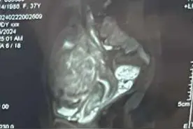 今天早晨咨询的一个子宫肌瘤案例值得科普，37岁，2次顺...图片