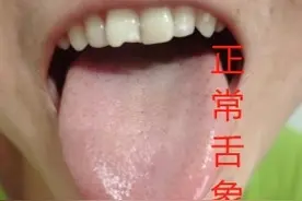 湿热，同样是黄舌苔，用药却完全不一样图片
