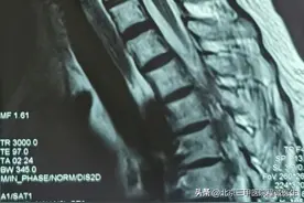 为什么片子看颈椎间盘突出很重，但自觉症状挺轻？图片