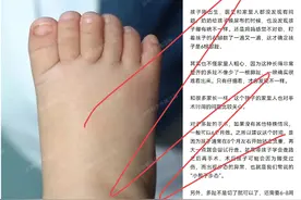 宝宝天生六趾，妈妈细心发现！专家建议6个月大手术图片
