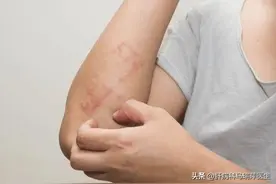 警惕！身上这三处发痒可能是肝病恶化信号图片