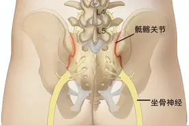 腰骶部疼痛是怎么回事？可能是肿瘤？如何应对？图片