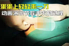 给下面轻轻来一刀，3D动画演示节育手术的操作过程，看完涨知识视频封面