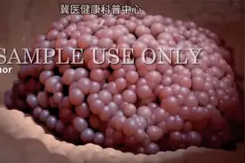 3D动画演示癌症放射治疗过程视频封面