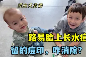 中德家庭：路易在学校得水痘，脸上留印可给我愁坏了，咋样能消掉视频封面