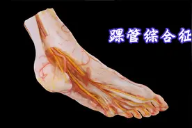 踝管综合征的踝管视频封面