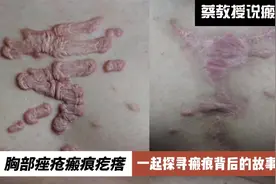 关于胸部痤疮瘢痕疙瘩的故事视频封面