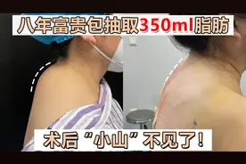 八年富贵包像“小山”，做手术抽取出350ml脂肪，术后立马平了！视频封面