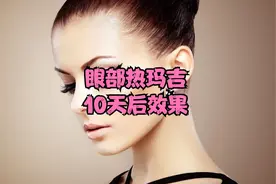 眼部热玛吉10天后效果、热玛吉多久见效~视频封面