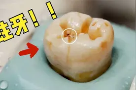 第1视角清理蛀牙，用电钻将牙齿掏空，牙齿棱角被钻平，看着真疼视频封面