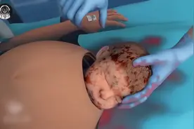 172.剖腹产手术究竟有多可怕？带你了解剖腹产手术的全过程#科普视频封面