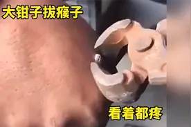 大钳子拔瘊子，看着都疼视频封面