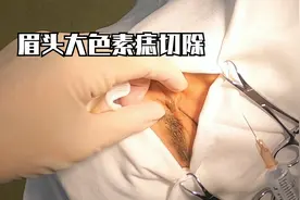 【手术实录】眉 有 大 痣视频封面