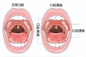 什么是口腔溃疡？口腔溃疡是不是上火？医生详细讲清图片