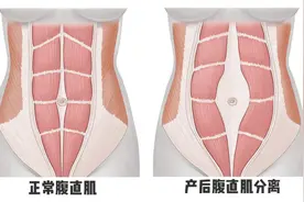 一文带你搞清产后腹直肌分离？如何自测？图片