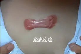 秋季增生性疤痕发痒怎么办？图片