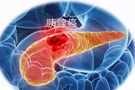 胰腺癌一发现即晚期？提醒：身体有5大异常，或是胰腺求救信号！图片