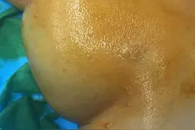 西地那非（伟哥）治疗严重淋巴管畸形图片