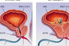 非那雄胺与盐酸坦索罗辛治疗前列腺增生哪个更好？如何选择？图片
