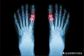“嘌呤大户”被揪出，你认为的美味佳肴，或会升高尿酸，别太贪嘴图片