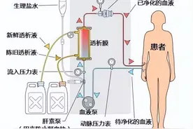什么是血液透析？血透的工作原理是什么？图片
