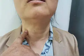甲减患者二做三不做图片