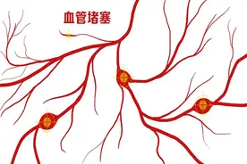 47岁男子，血管狭窄90%没放支架，现在变成40%，他是怎么做到的？图片