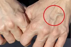 有的人手“青筋暴起”，有的人几乎看不到青筋，哪个健康？图片