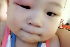 宝宝被蚊子咬后又肿又痒，咋办？宝妈亲测方法有效，完全可以效仿图片