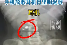 男子半夜睡觉误吞蓝牙耳机致胃里播放音乐 ，当事人：正在吃泻药，希望能排出来图片