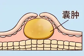 医生提醒：大多数囊肿无需处理，但若囊肿出现在5个地方，需警惕图片