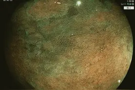 胃里的肠化不要怕，不要焦虑，认知比治疗重要图片