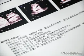 一分钟，教你看懂乳腺B超报告单，自我初步评估病情！图片