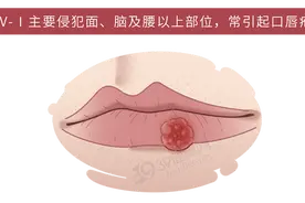 体内有癌，嘴巴知道？口腔若出现4种异常，或是癌症来临的信号图片