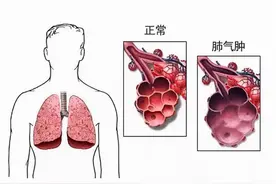 肺气肿？肺泡病理性扩张？出现呼吸困难？怎么延缓病情的发展呢图片